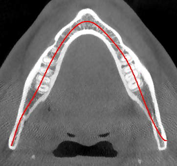 mandibular pic