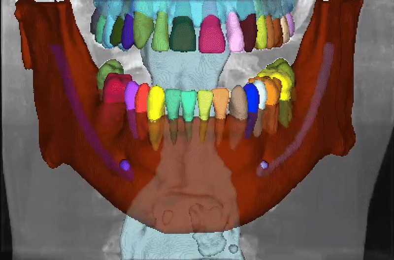 mandibular pic
